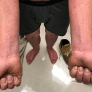Contact Dermatitis