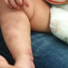 Idiopathic Thrombocytopenic Purpura