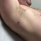 Focal Atypical Lymphoid Infiltrate With CD30 Positivity in a 36-Year-Old Man