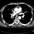 Non-Small Cell Lung Cancer