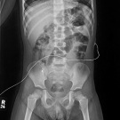 Foreign Body Appendicitis