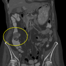 Association of Streptococcus sanguinis Infection With Colorectal Carcinoma