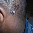 Angiolymphoid Hyperplasia With Eosinophilia