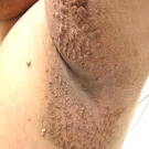 Acanthosis Nigricans