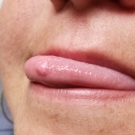 Intraoral Traumatic Fibroma