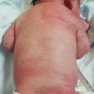 Klippel-Trénaunay Syndrome
