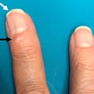 Malignant Peritoneal Mesothelioma With Refractory Ascites