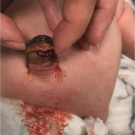 Patent Omphalomesenteric Duct Fistula