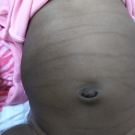 Transient Pigmentary Lines of the Newborn