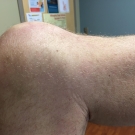 Posterior Cruciate Ligament Injury of the Knee