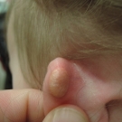 A Nodular Lesion on the Helix of a Boy’s Ear