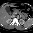 Acute Pancreatitis in Sickle Cell Vaso-occlusive Crisis