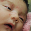 Neonatal Lupus Erythematosus