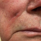 cutaneous sinus