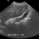 Giant Hepatic Hemangioma