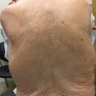 X-Linked Ichthyosis