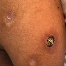 Lymphomatoid Granulomatosis Presenting as Cutaneous Lesions in a Patient With Holt-Oram Syndrome