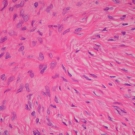 Chronic Intermittent Partial Torsion of a Benign Ovarian Fibroma