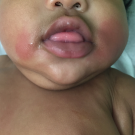 Popsicle Panniculitis