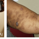 Plaque Psoriasis With Severe Hyperpigmentation in Skin of Color