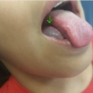 Ranula in a 13-Year-Old Girl