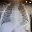 An Unusual Presentation of Human Metapneumovirus Infection