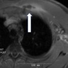 Staphylococcal Toxic Shock Syndrome From Methicillin-Susceptible Staphylococcus aureus Septic Costochondritis