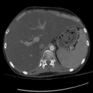 Hemophagocytic Lymphohistiocytosis