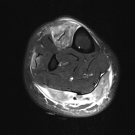 Vasculitis Presenting as Calf Pain With Muscle-Limited Involvement