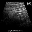 Atypical Appendicitis