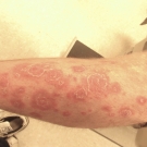 Scaly Red Plaques in a 22-Year-Old Man