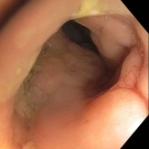 Extraintestinal Manifestations of Crohn Disease Mimicking Septic Arthritis