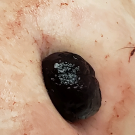 Pediatric Rectal Prolapse