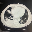 Hepatic and Pulmonary Abscesses From Fusobacterium nucleatum Infection