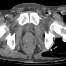 Gas Gangrene Associated With Clostridium septicum Infection