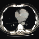Herpes Simplex Virus Esophagitis in an Immunocompetent Patient