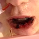 Mycoplasma pneumoniae–Induced Rash and Mucositis