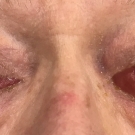 Bilateral Carotid Cavernous Fistulas