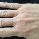 Parvovirus B19 Infection