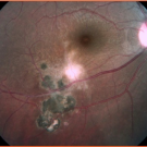 Ocular Toxoplasmosis