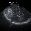 Severe Anemia Associated With Intracranial Hemorrhage in an Infant