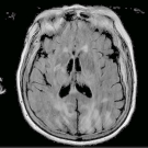Posterior Reversible Encephalopathy Syndrome in a Patient With Hypertension on Oral Methotrexate Therapy