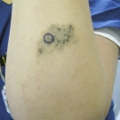 Agminated Blue Nevus Arising in a Nevus Spilus