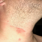 Folliculitis Barbae
