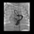 Isolated Congenital Left Coronary Artery to Coronary Sinus Fistula in a Neonate