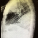 Legionella Pneumonia