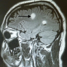 Multiple Sclerosis Presenting as Bell Palsy