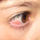 Episcleritis