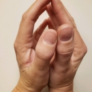 Limited Joint Mobility Syndrome