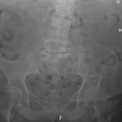 Transiliac Lumbar Hernia